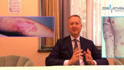 »Če psoriaza ni ustrezno zdravljena, v organizmu svojo pot skrivaj nemoteno nadaljuje proces drugih obolenj ...«
