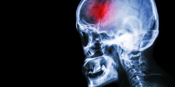 Možganska kap – edini pravi recept je takojšnje ukrepanje!