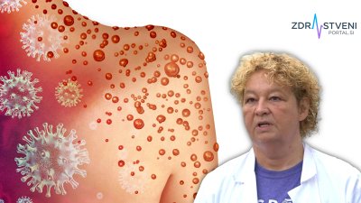 Opičje koze (mpox) – kakšni so simptomi in kako se razlikujejo od znakov drugih virusnih obolenj, kako se odvija zdravljenje, v katerih primerih je smiselno cepljenje in kako dolgotrajna je kužnost obolelega