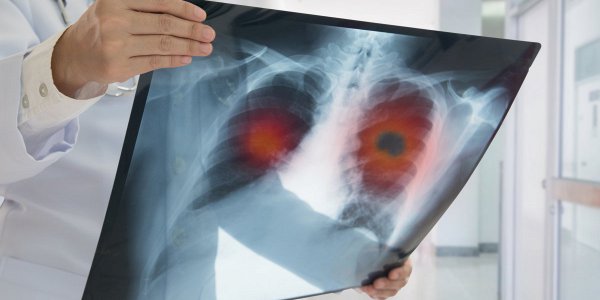 Rak pljuč – bolezen, zaradi katere še vedno umre več ljudi kot zaradi raka na prsih, na debelem črevesju in na prostati skupaj