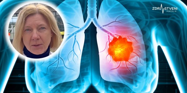 Recept za zgodnejše odkrivanje in učinkovitejše zdravljenje pljučnega raka prinaša nacionalni presejalni program, a tlakovanje poti do uvedbe tega programa bo, kot poudarja doc. dr. Martina Vrankar, trajalo še nekaj let 