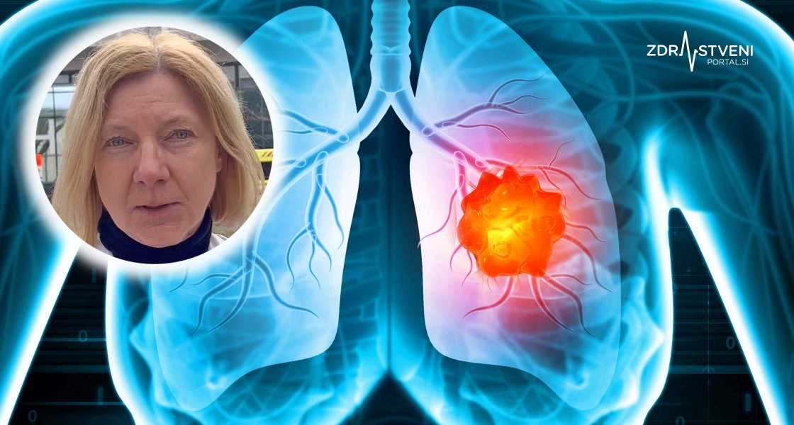 Recept za zgodnejše odkrivanje in učinkovitejše zdravljenje pljučnega raka prinaša nacionalni presejalni program, a tlakovanje poti do uvedbe tega programa bo, kot poudarja doc. dr. Martina Vrankar, trajalo še nekaj let 
