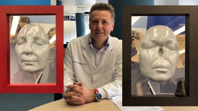 Rekonstrukcija nosu na podlahti s pomočjo 3D modela – slovenska inovacija je pacientki po amputaciji nosu zaradi kožnega raka omogočila novo življenje