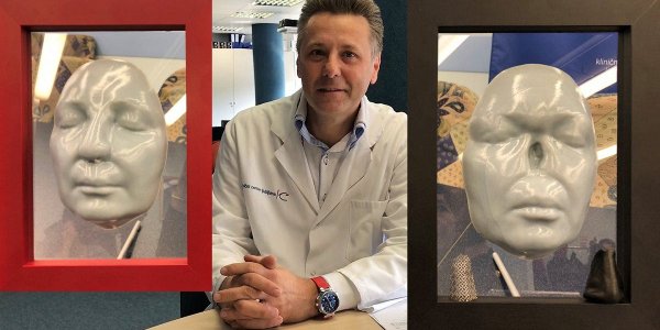 Rekonstrukcija nosu na podlahti s pomočjo 3D modela – slovenska inovacija je pacientki po amputaciji nosu zaradi kožnega raka omogočila novo življenje