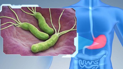 Se tudi pri obvladovanju raka želodca kmalu obeta presejalni program in posledično bistveno boljše preživetje bolnikov s to diagnozo?