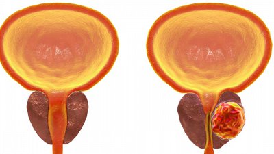 »Zelo pomembno je, da se bolezen odkrije pravočasno, sicer bolniku lahko ponudimo le še paliativno obravnavo!« – asist. dr. Marina Mencinger o zapoznelih diagnozah raka prostate in karcinoma mehurja