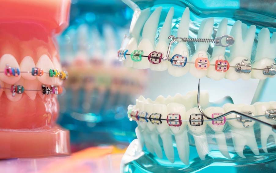 Otroška ortodontija