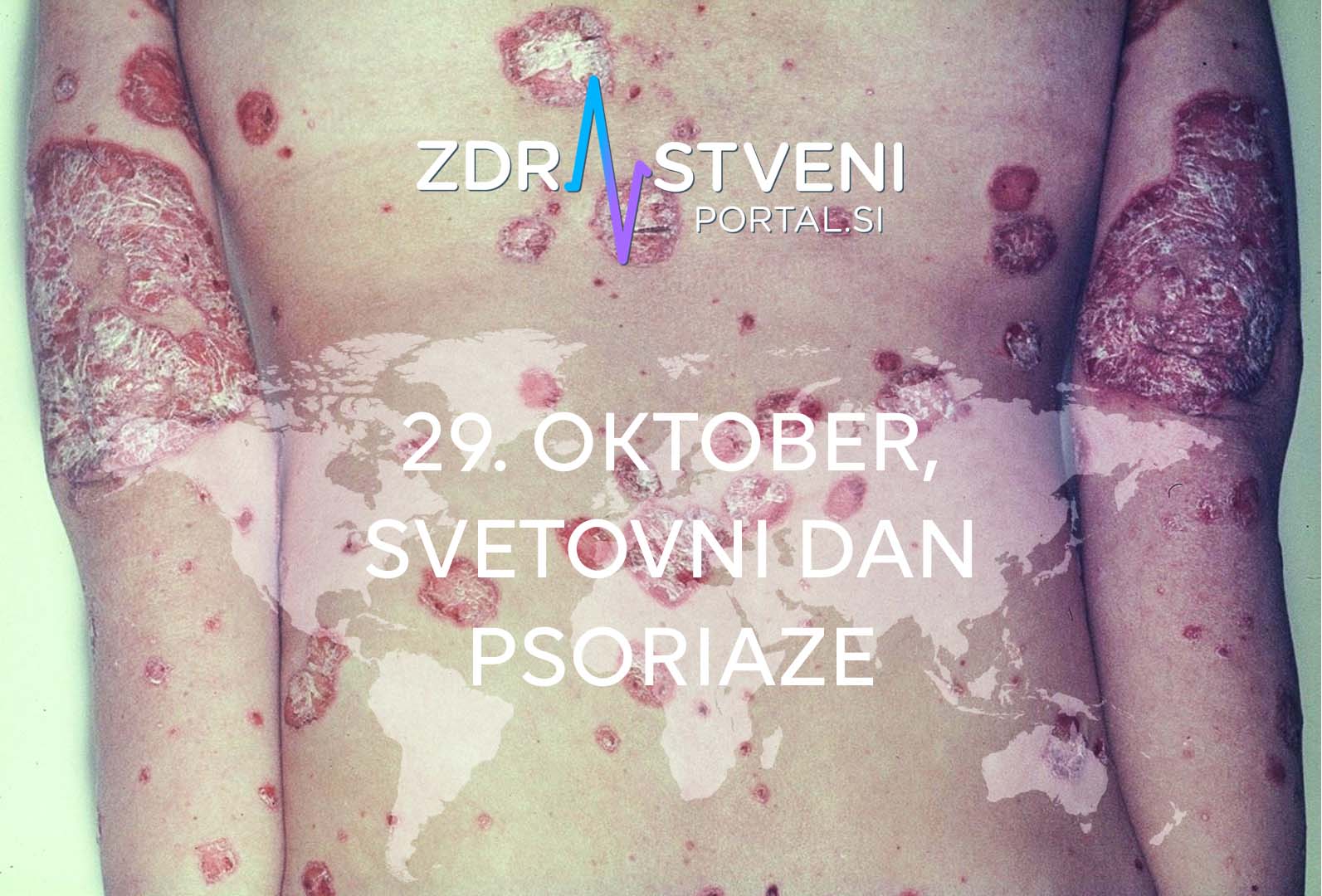 29. oktober, svetovni dan psoriaze