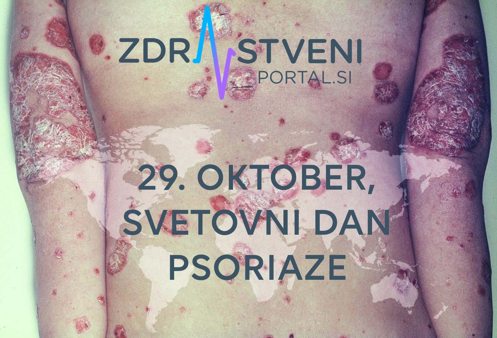 29. oktober, svetovni dan psoriaze