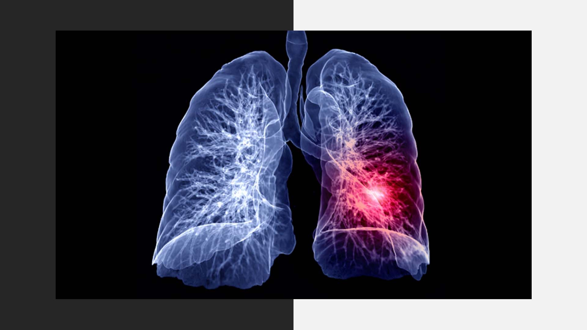 rak pljuč