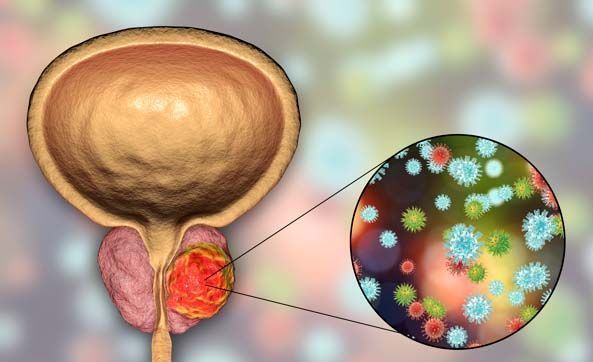 Rak prostate