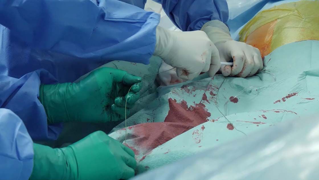 Implantacija aortne zaklopke brez odpiranja prsnega koša