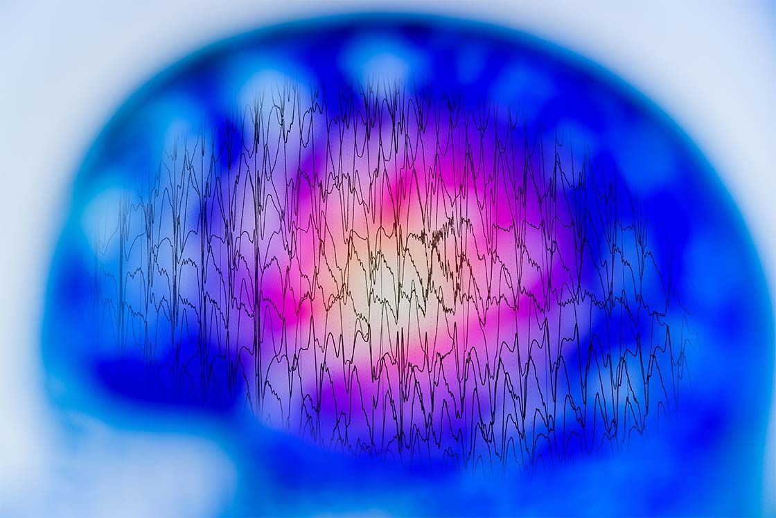 epileptični napadi – kirurško zdravljenje